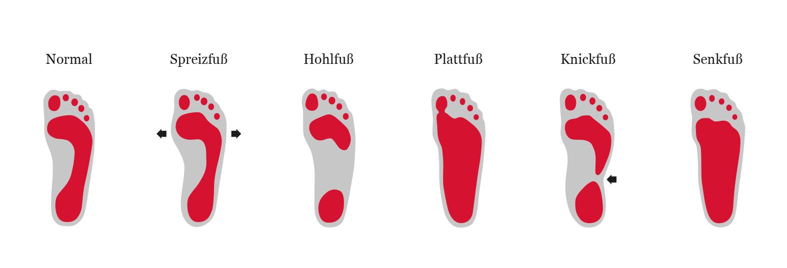 Fussfehlstellungen