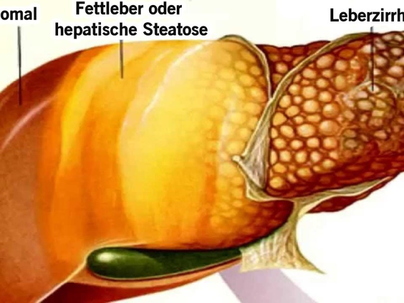 Fettleber